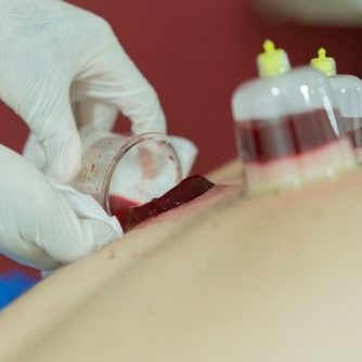 Acupuncturist performs massage cupping therapy, hacamat of Muslim Traditional Medical